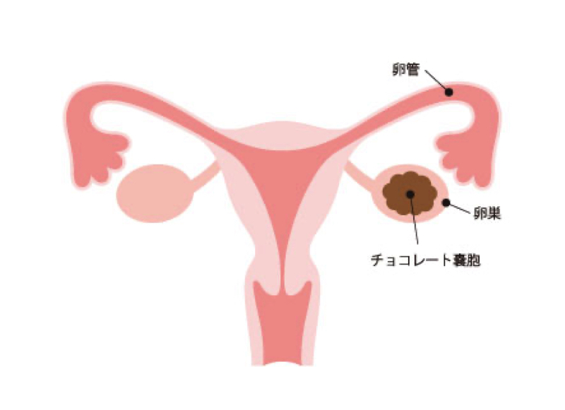 チョコレート嚢胞（卵巣子宮内膜症）